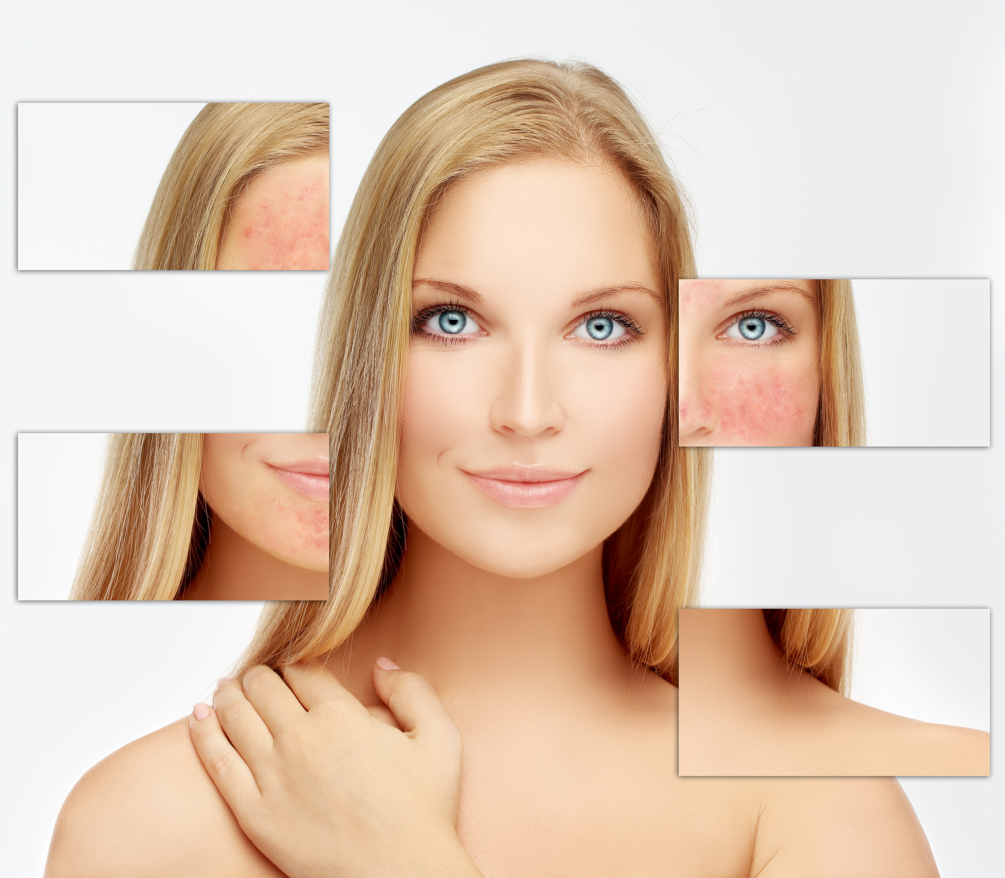 rosacea